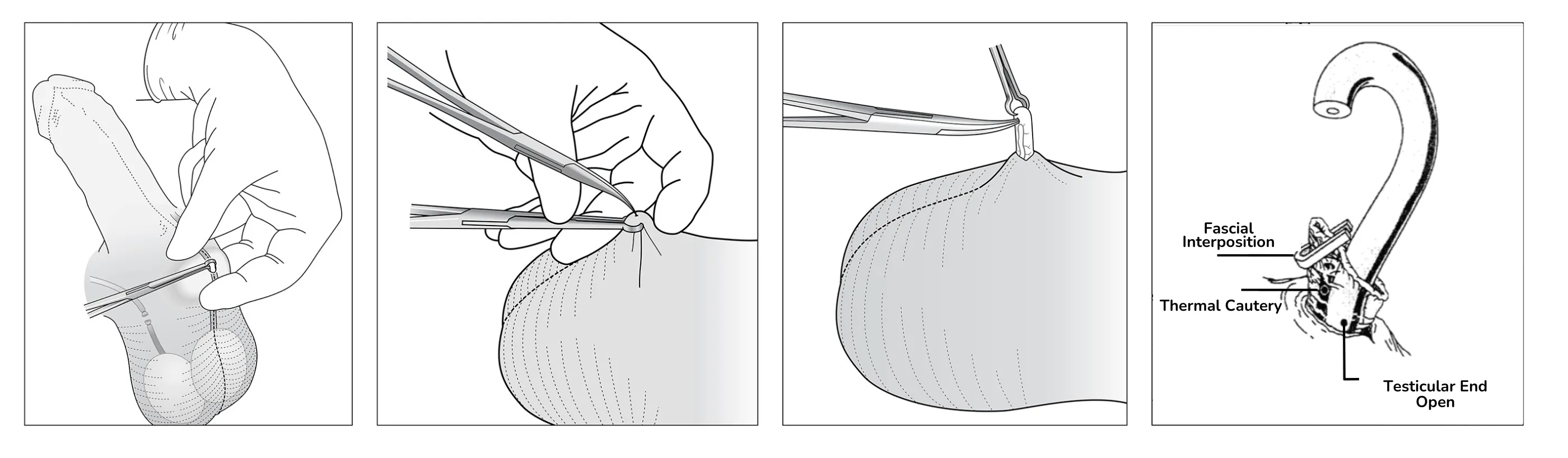 Vasectomy Procedure